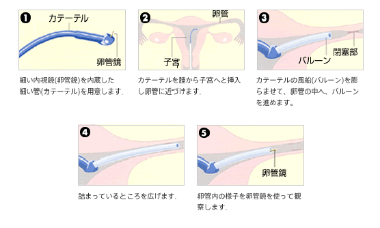 FT（卵管鏡下卵管形成術）とは